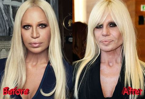 storia di donatella versace è figlia|donatella versace before and after surgery.